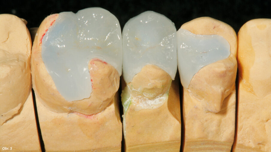 Pracovní model vyrobený na základě polysiloxanového otisku s dokončenými keramickými náhradami.