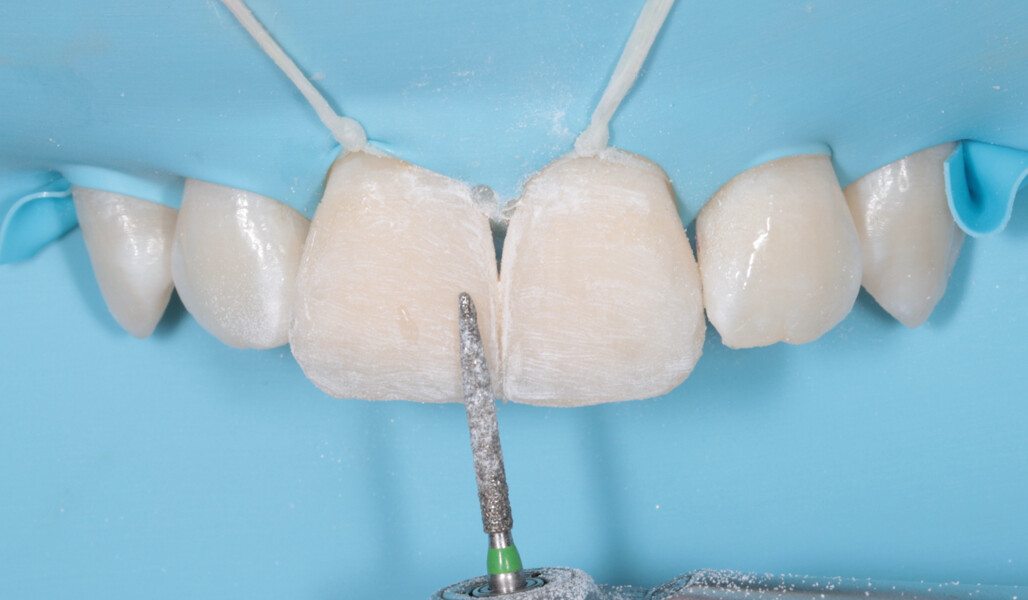 Fig. 19: Finishing with a diamond bur.