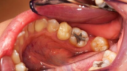 Primeira universidade brasileira a promover descarte ecológico de amálgama dentária