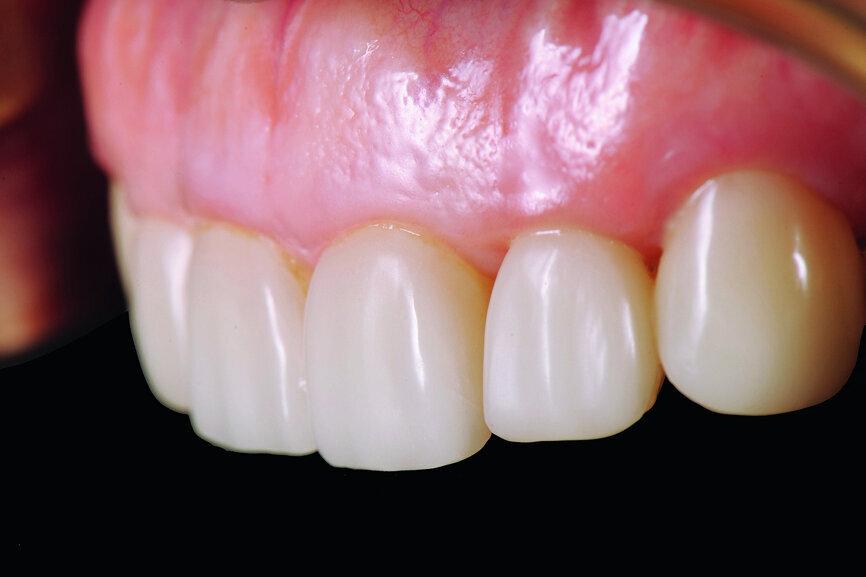 Fig. 28: Four-year follow-up: lateral view of upper-anterior dentition.