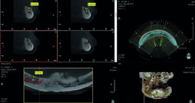 Digitising your implant practice