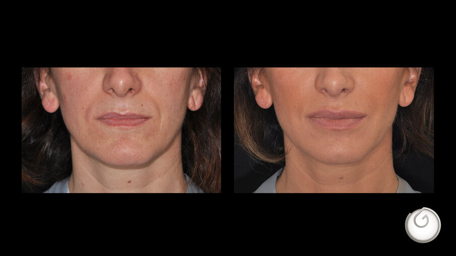 Prima e dopo il trattamento