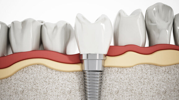 Immunreaktion bei Implantaten vermeiden