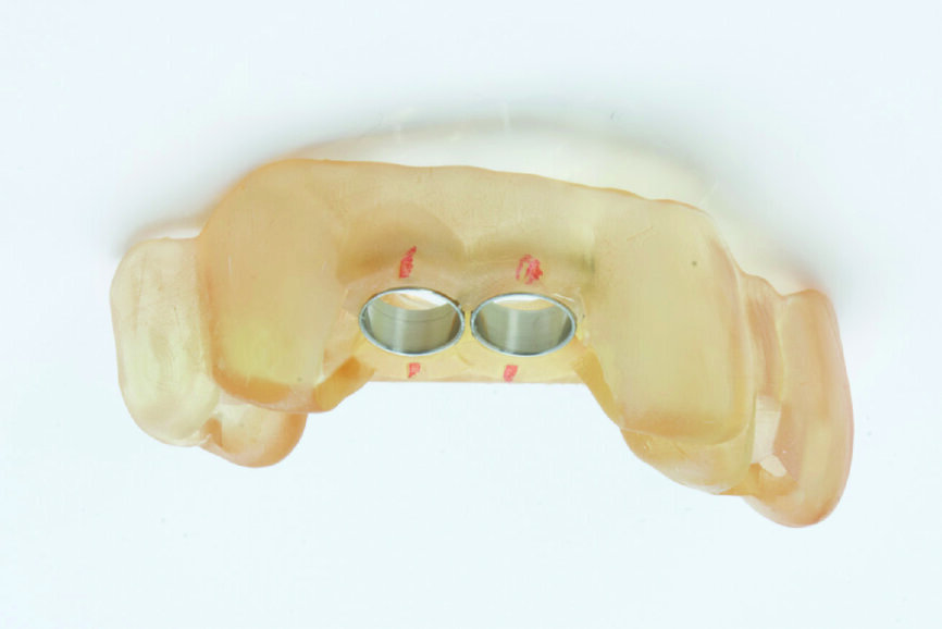 Fig. 1 : Guide chirurgical. 