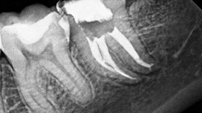 PHAST PIPS: The photoacoustic wave of the future?