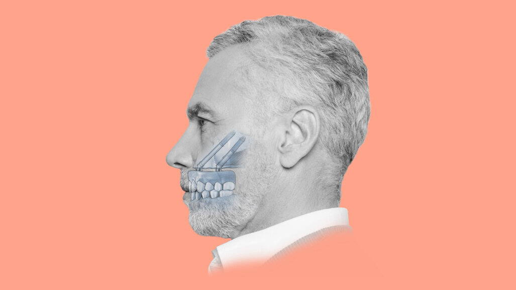 Advancing zygomatic implantology: Nobel Biocare’s Zygoma Academy drives clinical excellence