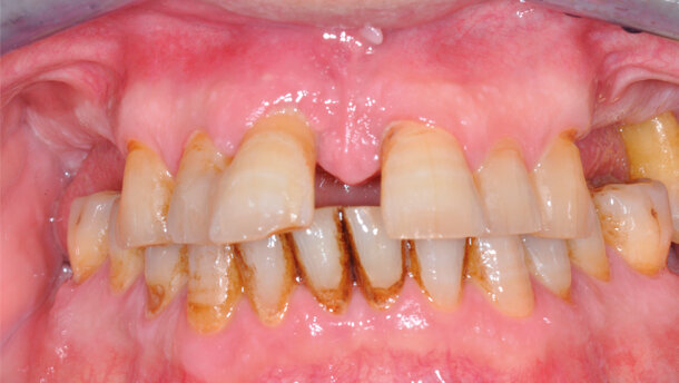 Riabilitazione a carico immediato  con impianti a connessione  conometrica: report di un caso  con due anni di follow-up