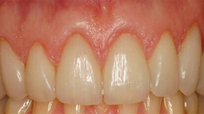 Two-stage esthetic crown lengthening Two-stage esthetic crown lengthening