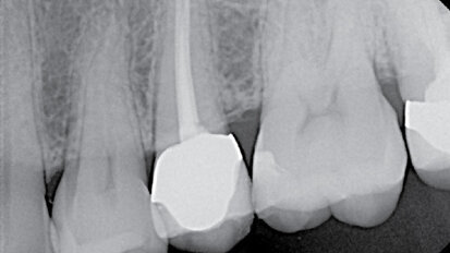 Problematika kalcifikovaných kanálků, kazuistika