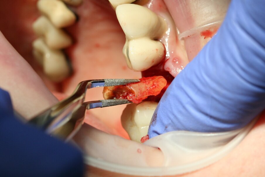 Fig. 8: The root could be lifted out with diamond-coated tweezers. 