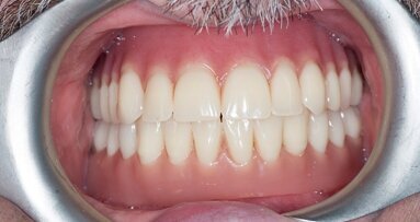 Rehabilitacja protetyczna z zastosowaniem protezy całkowitej wspartej o implant – opis przypadku