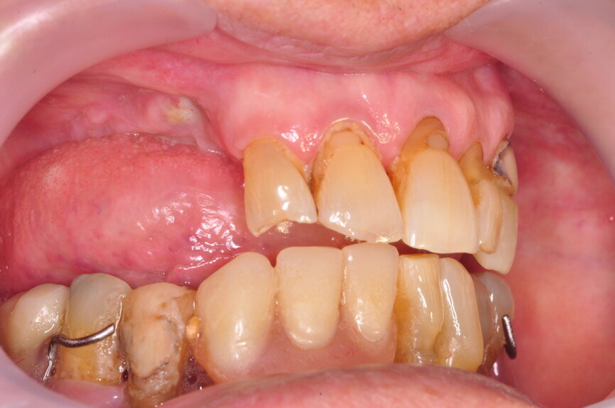 Ryc. 1-3_Stan przed leczeniem: 1. Zdjęcie wewnątrzustne