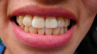 Genetica e morfologia degli sherpa del Nepal: allo studio tramite saliva ed impronte dentali