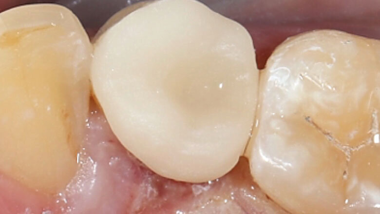 Fig. 11. La restauración de cerámica de feldespato durante la prueba clínica en boca.