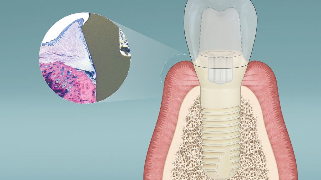 Patent Dental Implant System