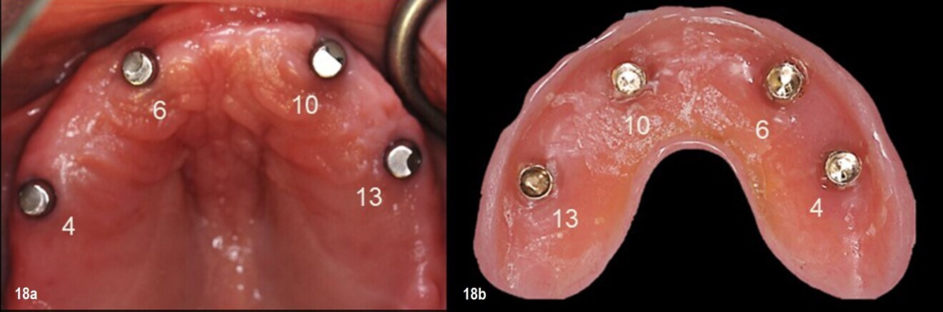 Figs. 18a & b: Milled parallel Atlantis Conus abutments placed on to the integrated maxillary implants in the sites of the maxillary right second premolar, right canine, left lateral incisor and left second premolar (a). Intaglio surface of the maxillary overdenture with receptacles for the Atlantis Conus abutments (b).