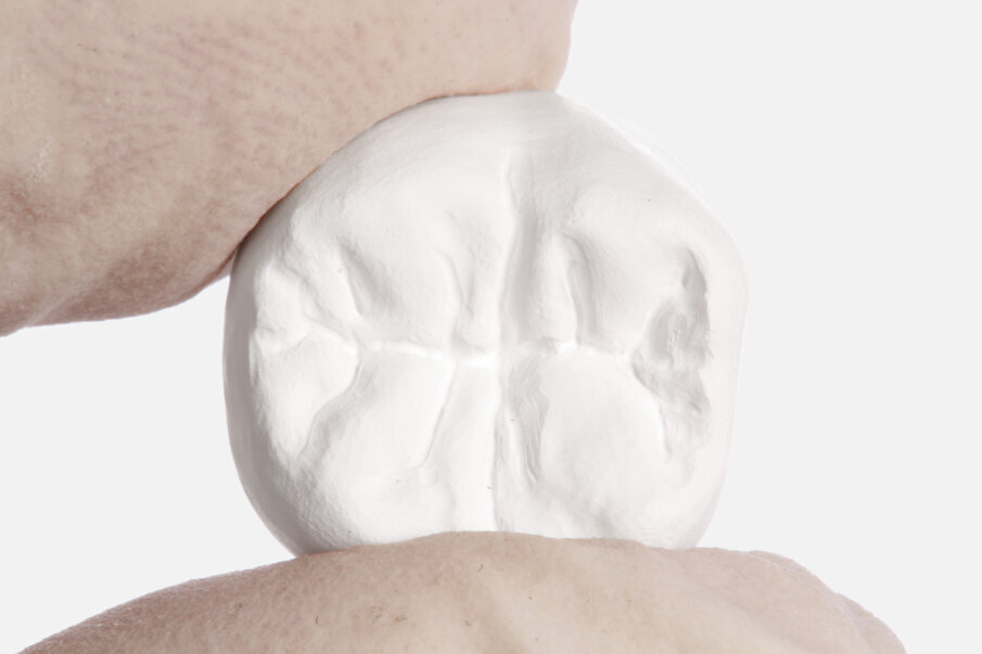 Fig. 11: If required, the fissures can be recontoured with a pointed carbide cutter.