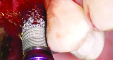 Zimmer lance un implant avec une fonctionnalité d'ostéo-incorporation