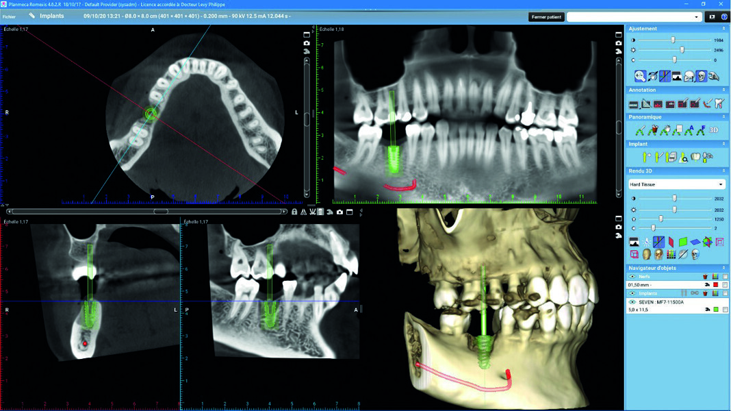 Fig. 4 : Planification implantaire. 