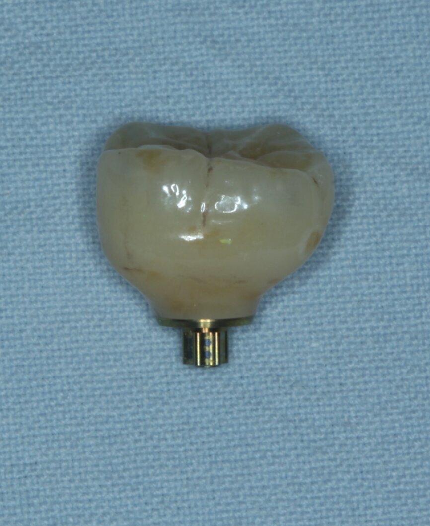 Fig. 18: Temporary crown.