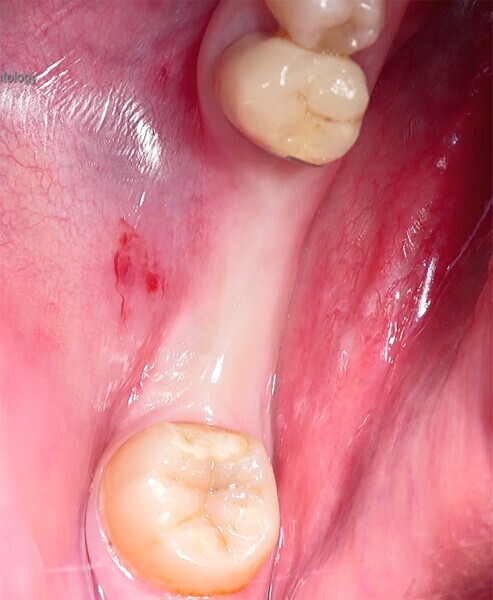 Fig. 25  : Zone édentée trop étroite, inadaptée à une pose d’implant. 