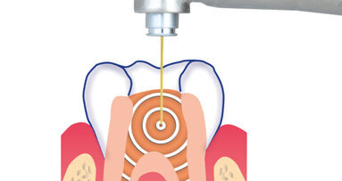 SSP/SWEEPS endodoncie se SkyPulse Er:YAG laserem