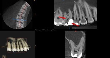 Wykorzystanie CBCT w pierwotnym leczeniu kanałowym zęba z zębiniakiem
