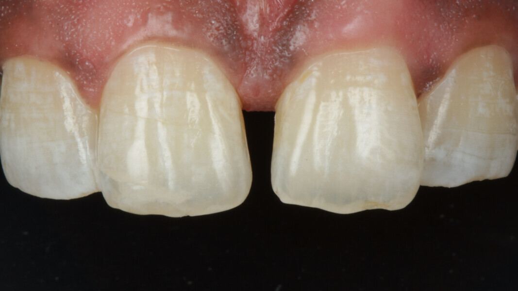 Fig 1: Pre-op showing midline diastema.