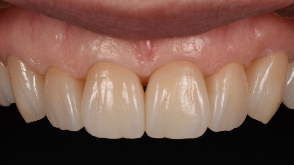 One step closer to nature: Occlusal concepts and sophisticated aesthetics in digital dentistry