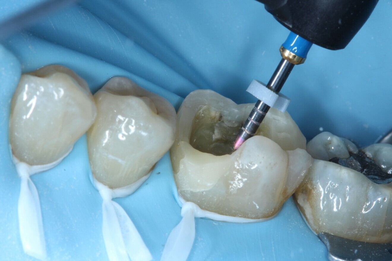 Fig. 9: Hyflex EDM Finishing file in situ using tactile controlled activation.