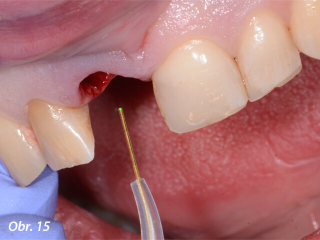 Dezinfekce poextrakčního lůžka použitím laseru Nd:YAG Fotona.