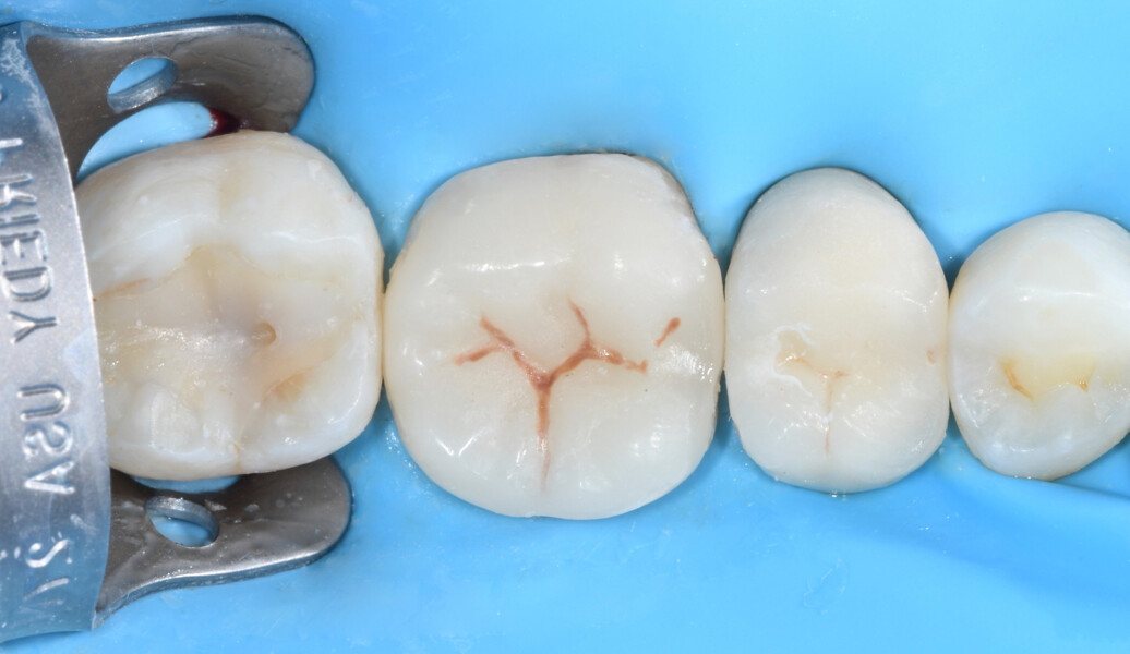 Fig. 11b: Endocrown after finishing and polishing under dental dam isolation.