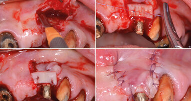 Riabilitazione totale di tipo estetico-funzionale con terapia parodontale, implantare, protesica, mucogengivale e gnatologica