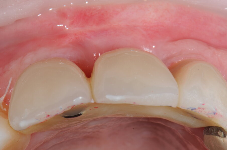 Fig. 23 - Posizionamento della protesi provvisoria.