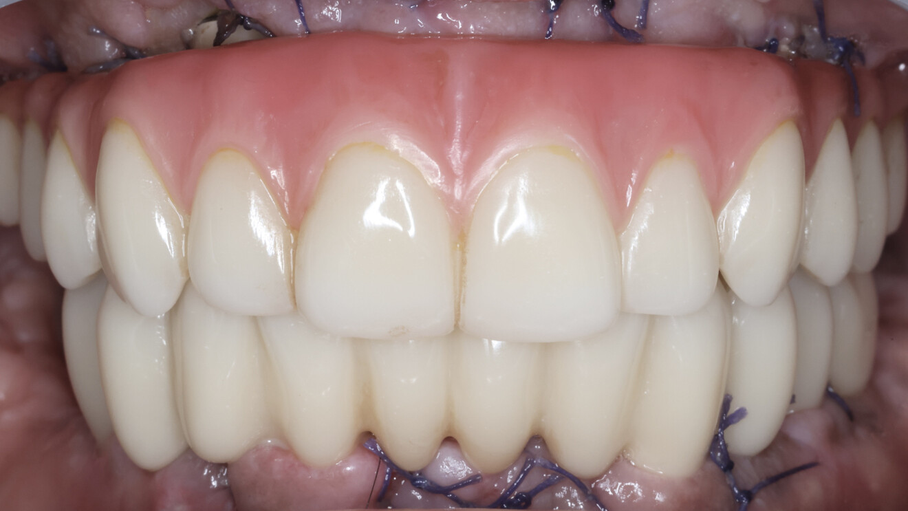 Fig. 14b: Mandibular provisional prosthesis in occlusion with the maxillary provisional prosthesis after delivery on the third day after mandibular surgery.