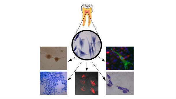 Denti da buttare? No, grazie. Meglio  conservarli per le cellule staminali della polpa