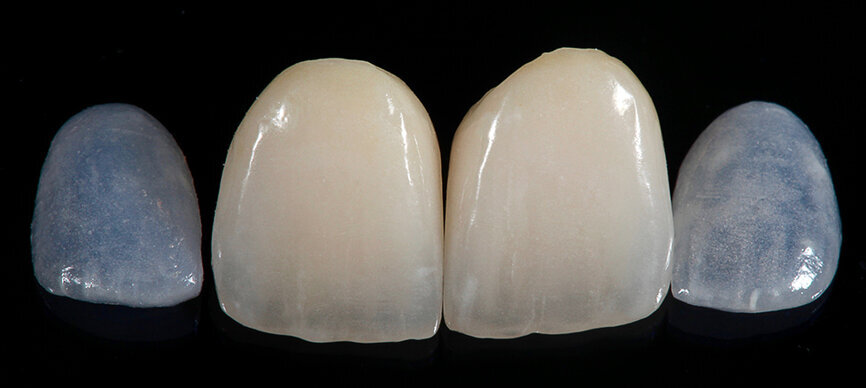 Fig. 12. El resultado final tras el acabado, la caracterización y el glaseado con VITA AKZENT Plus y el pulido.