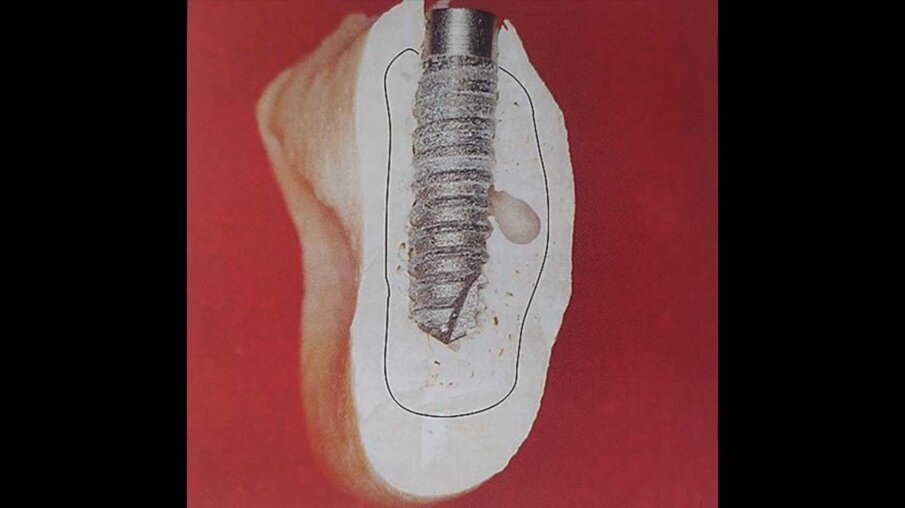 Fig. 7b_Modello sezionato di una mandibola con impianto.