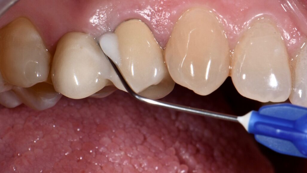 Effetti clinici dell’applicazione sottogengivale di un gel a base di Xantano e Clorexidina nel trattamento delle malattie peri-implantari