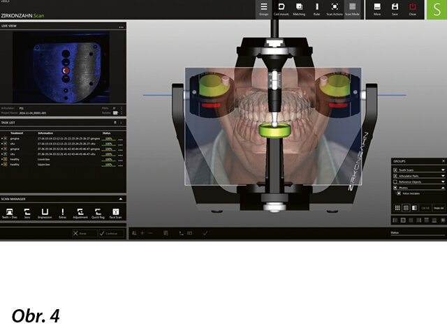 Nastavení individuálních parametrů konkrétního pacienta v programu Zirkonzahn.Archiv. V něm uložené údaje se importují do programu Zirkonzahn.Scan a dojde k fúzi dat.