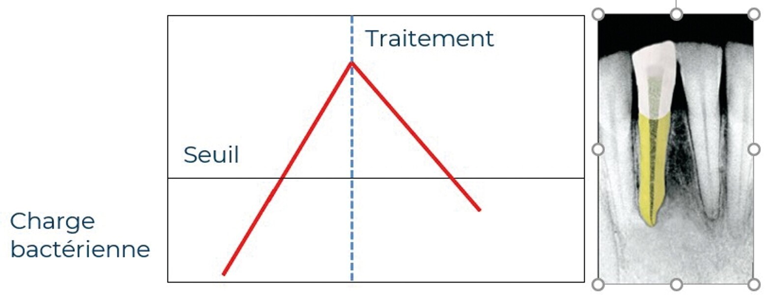 Fig. 4 : Illustration de la guérison d’une lésion après traitement endodontique lorsque l’on parvient à repasser sous la valeur du seuil.