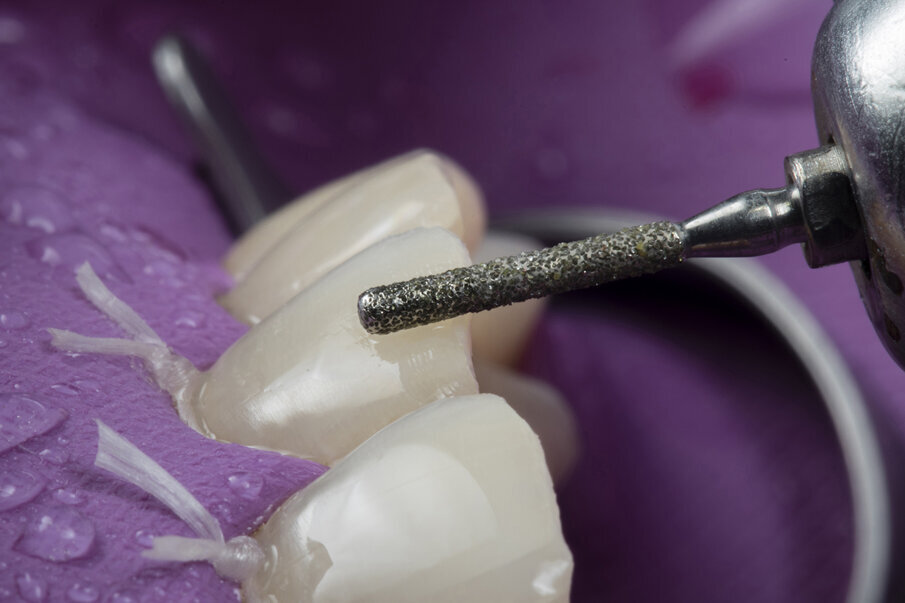 Fig. 5: Labial bevelling of fractured area