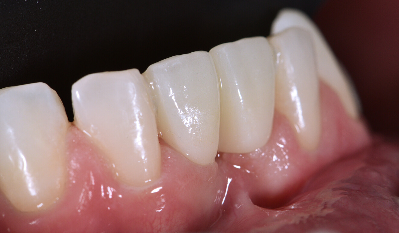 Fig. 10: Lateral view of the restoration immediately after cementation.