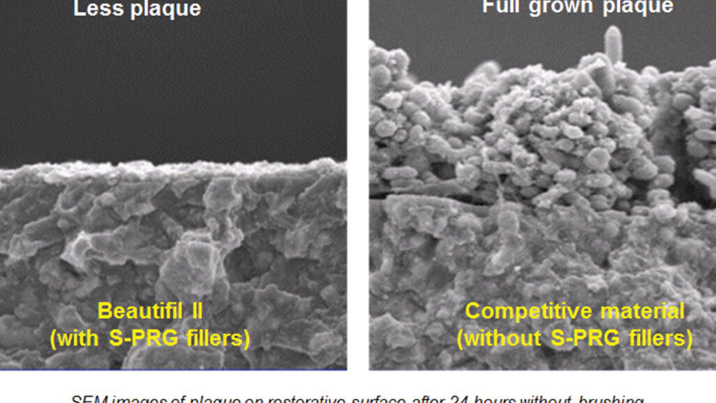 Beautifil II, un composite bioactivo y biomimético que libera fluoruro