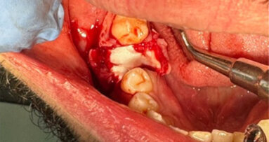 Conservation de la muqueuse attachée vestibulaire et linguale lors d’avulsions grâce à R.T.R.+ membrane