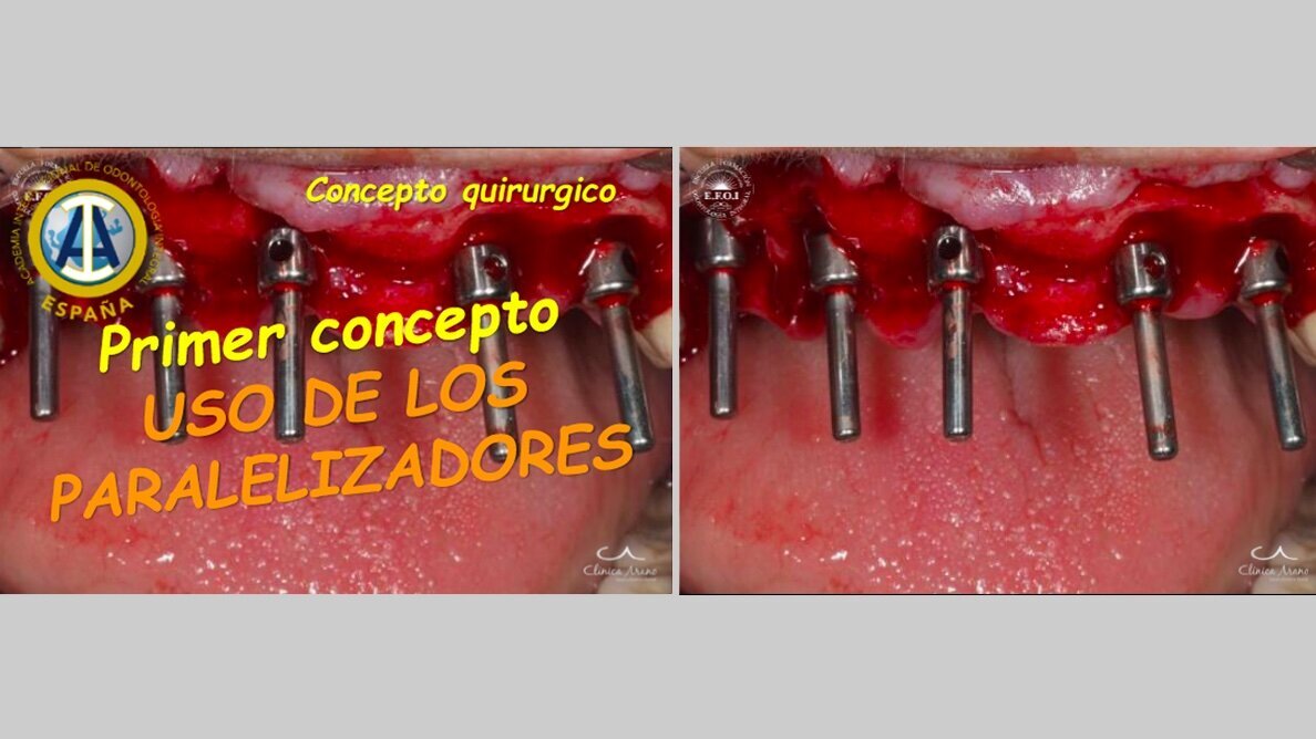 Implantología simple y eficaz