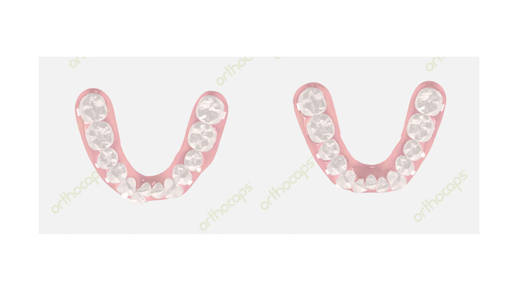 Figs. 21 & 22: Simulation showing the planning for the indirect partial lingual auxiliary—hybrid aligner treatment.