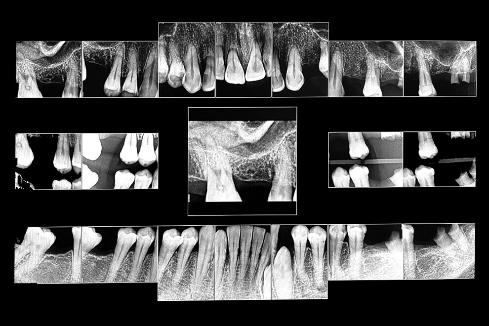 Fig. 11a: Full-mouth radiograph series revealing caries and periodontal defects. 