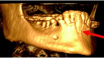 Eziologia dei diversi tipi di insuccesso in implantologia orale