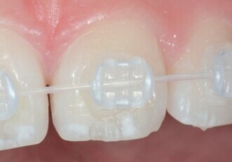 Discovery Pearl ceramic bracket Discovery Pearl ceramic bracket